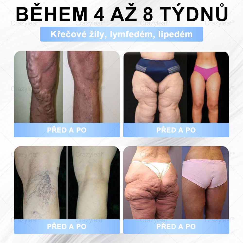 FDA Store |𝐵uil𝗱𝐿ea𝐟® 𝑮𝐋𝑃-1 zeštíhlující a zpevňující nanojehličková náplast s kolagenem, kurkumou a Matrixylem 3000 │ Obezita, kardiovaskulární onemocnění, cukrovka, spánková apnoe, problémy s klouby a další